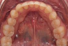 Bottom teeth after Invisalign
