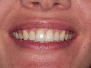 After treatment with Invisalign in Harley Street, London