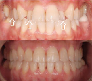 Braces treatment from our orthodontist in London