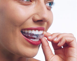 Invisalign-placement-of-the-Aligner-london-(1)