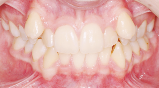 before-braces-1024x566
