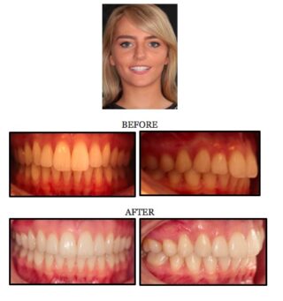 invisalign-before-after-1