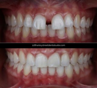 Closing the gap between the front teeth using a specialist orthodontist and Invisalign braces