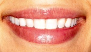 teeth-whitening-after-300x171