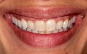 teeth-whitening-before-300x186